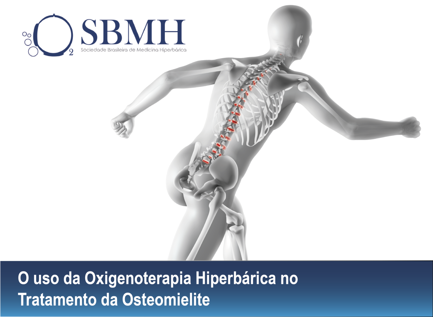 O uso da Oxigenoterapia Hiperbárica no Tratamento da Osteomielite<
